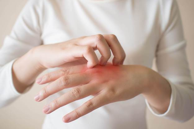 The Relationship Between Eczema and Heavy Metal Toxicity